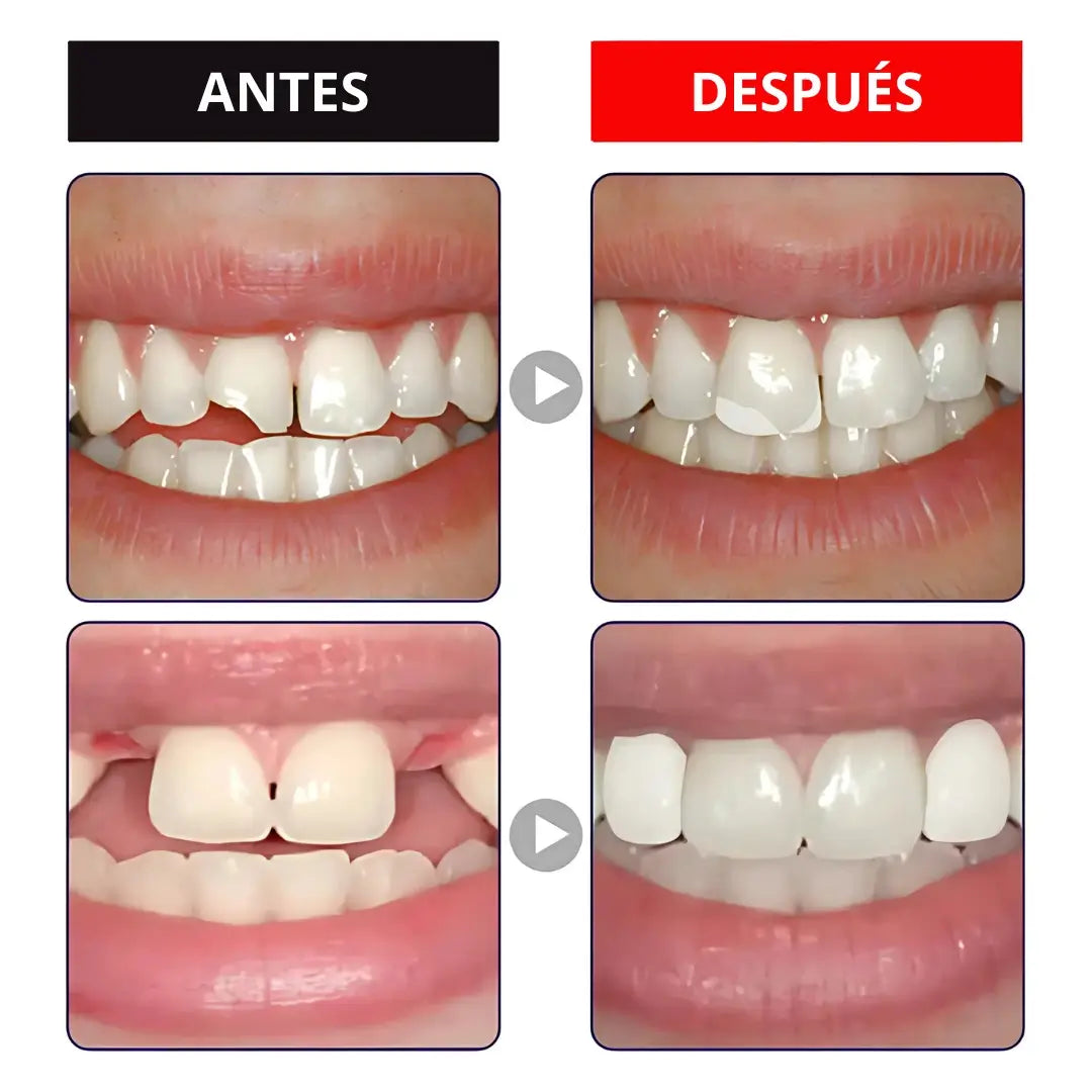 Instasmile™ | Sonrisa perfecta al instante, ¡Adiós inseguridad!