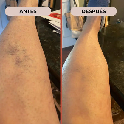 Circuvarice® |  Piernas Ligeras, Confianza Instantánea